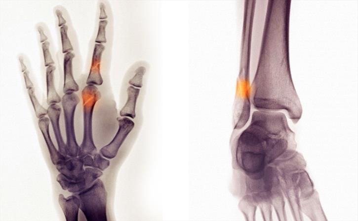 Is young India falling prey to orthopedic problems? 